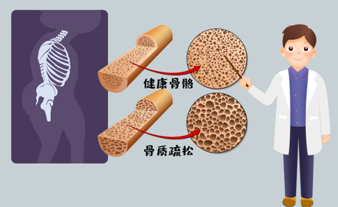 骨骼衰老是“静悄悄的杀手” 防治要点在于抗衰